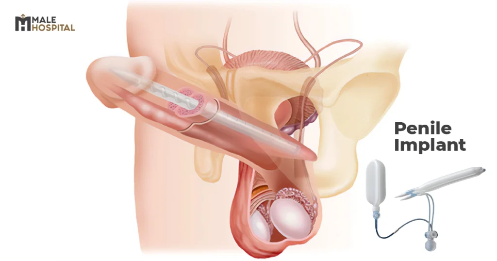 Penile Implant