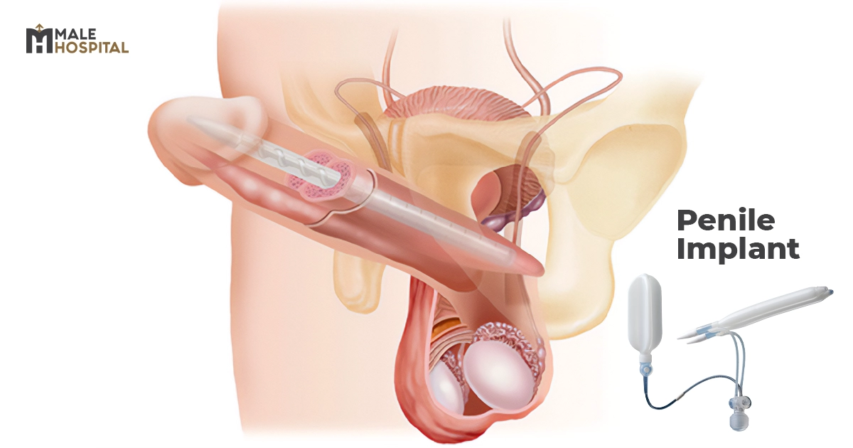 Penile Implant