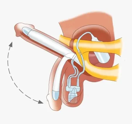 All-Inclusive AMS LGX 700 Penile Prosthesis Package Penile Implant Surgery