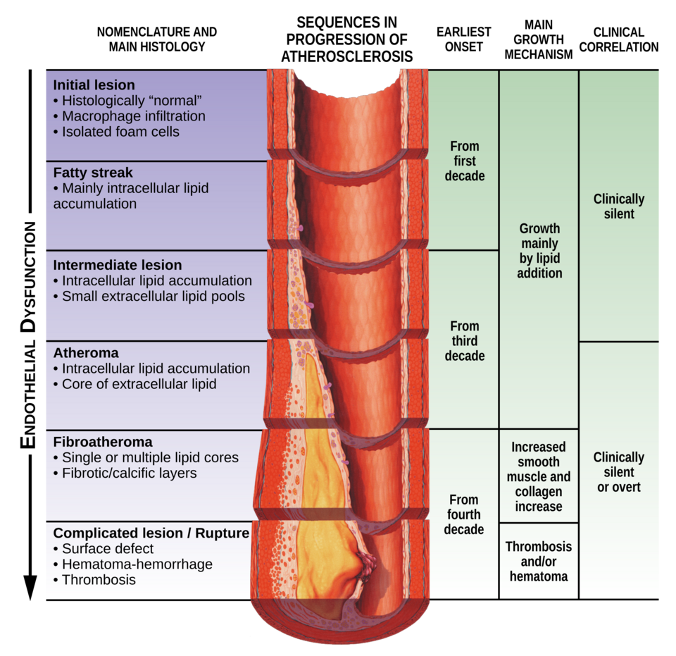Diagram of the stages of endothelial dysfunction and atherosclerosis, a key mechanism linking erectile dysfunction and diabetes