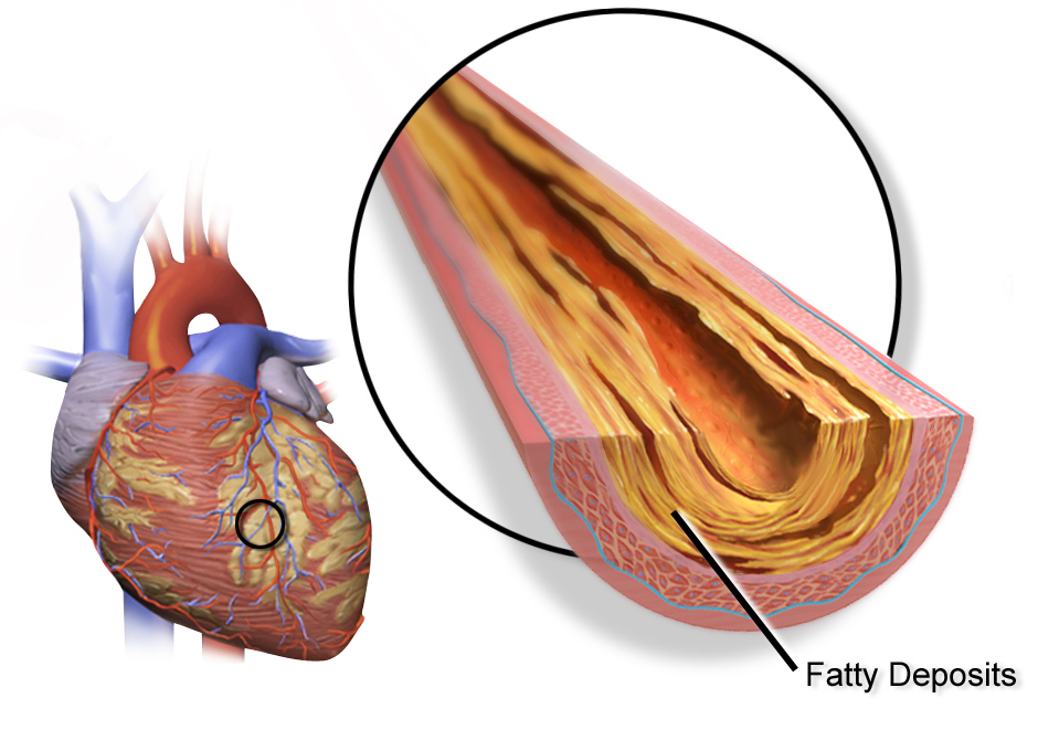 Erectile dysfunction and heart disease: diagram of a coronary artery narrowed by fatty plaque