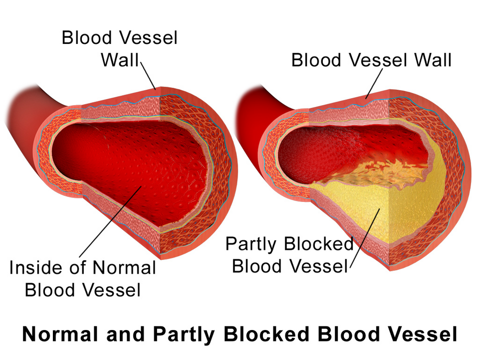 Diagram of a normal artery and an artery partially blocked by plaque, the most common of the erectile dysfunction causes