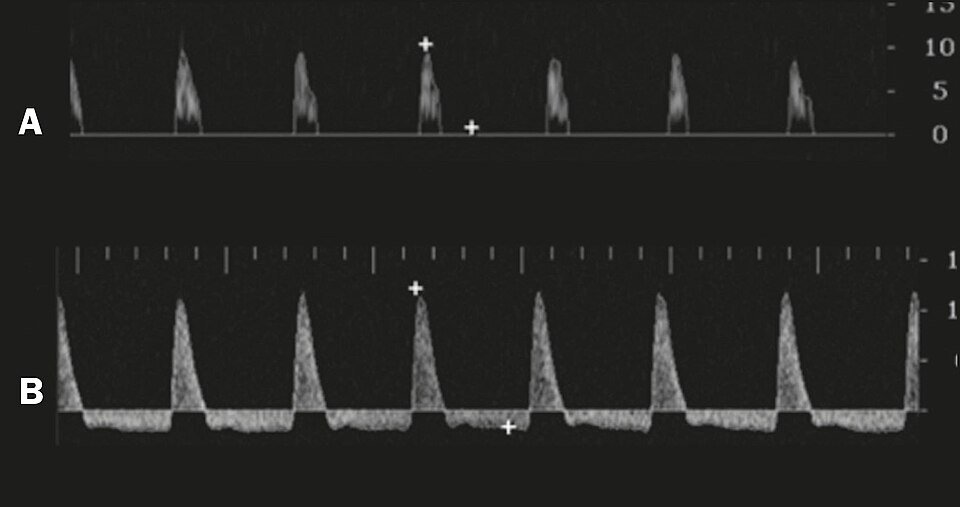 Penile Doppler ultrasound tracings of cavernous artery blood flow, a specialized erectile dysfunction test