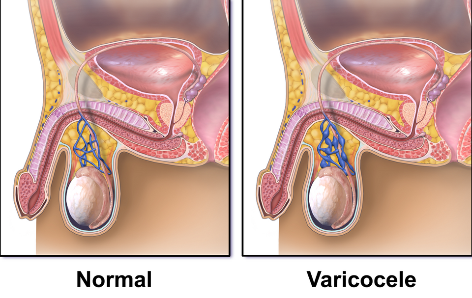 Medical illustration comparing normal scrotal veins with a varicocele, a common cause of male infertility