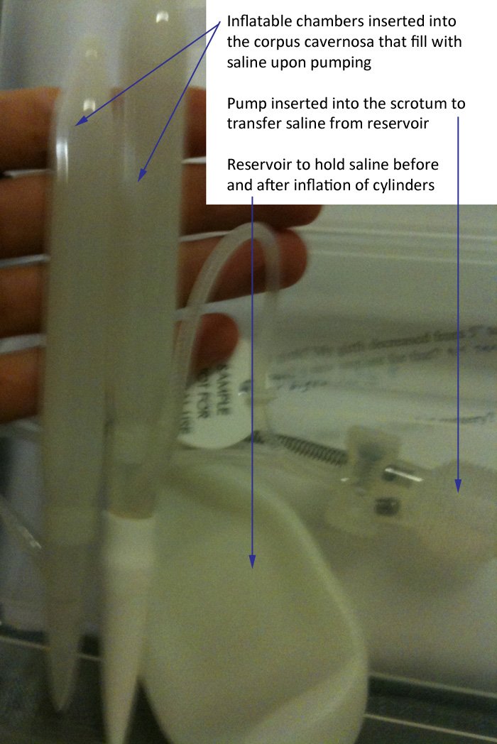 Three-piece inflatable penile prosthesis with cylinders, pump and reservoir, the parts involved in penile implant complications