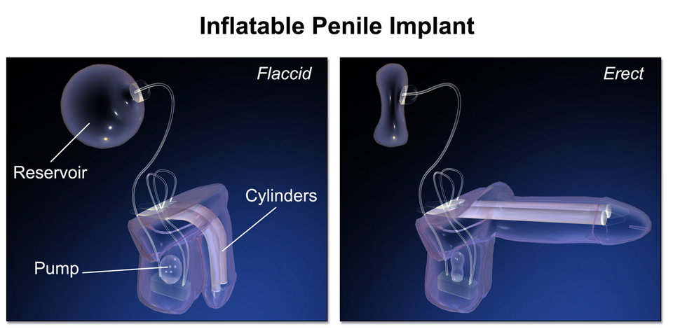 Diagram of an inflatable penile implant showing reservoir, pump and cylinders, relevant to penile implant recovery and cycling