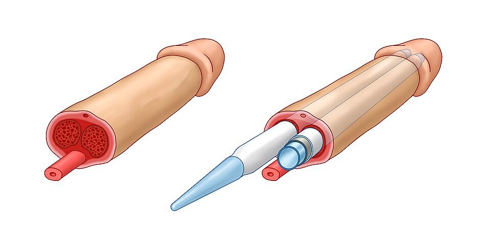 Diagram of an inflatable penile implant with cylinders placed in the corpora cavernosa
