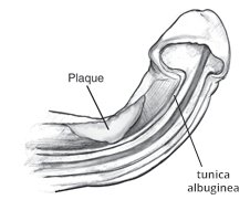 Diagram of a Peyronie's disease plaque in the tunica albuginea causing penile curvature, relevant to Peyronie's disease treatment