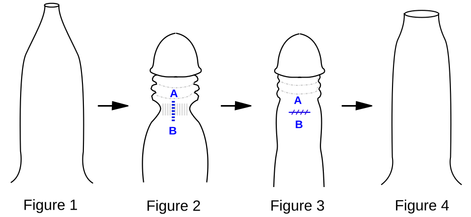 Diagram of phimosis with a tight foreskin ring and the steps of preputioplasty