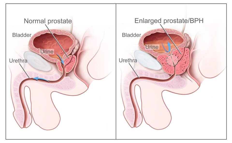 Tadalafil daily dose for BPH: diagram of a normal prostate and an enlarged prostate narrowing the urethra